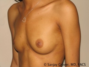 Breast Augmentation Before and After 21 | Sanjay Grover MD FACS