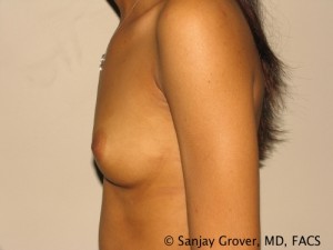 Breast Augmentation Before and After 21 | Grover Aesthetics