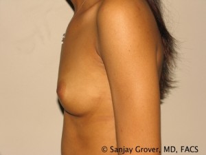 Breast Augmentation Before and After 21 | Sanjay Grover MD FACS