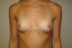 Breast Augmentation Before and After | Grover Aesthetics