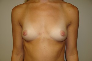 Breast Augmentation Before and After | Grover Aesthetics