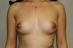 Breast Augmentation Before and After | Grover Aesthetics