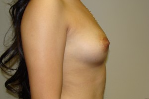 Breast Augmentation Before and After 217 | Grover Aesthetics