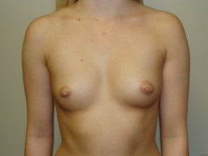 Breast Augmentation Before and After | Grover Aesthetics