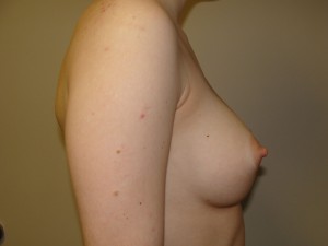 Breast Augmentation Before and After 219 | Grover Aesthetics