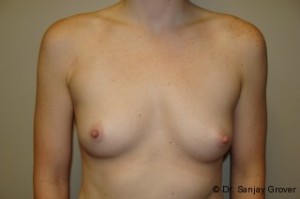 Breast Augmentation Before and After | Grover Aesthetics