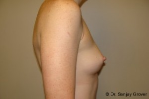 Breast Augmentation Before and After 220 | Grover Aesthetics