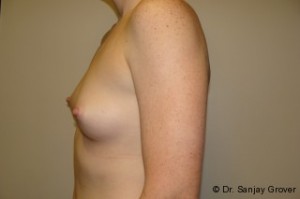 Breast Augmentation Before and After 220 | Grover Aesthetics