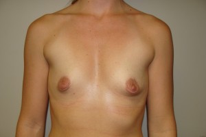 Breast Augmentation Before and After 260 | Sanjay Grover MD FACS