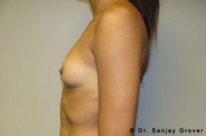 Breast Augmentation Before and After 224 | Grover Aesthetics