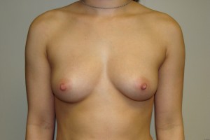 Breast Augmentation Before and After | Grover Aesthetics