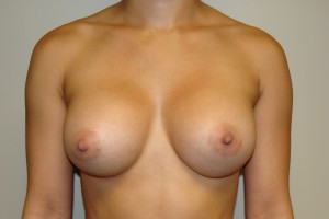 Breast Augmentation Before and After | Grover Aesthetics