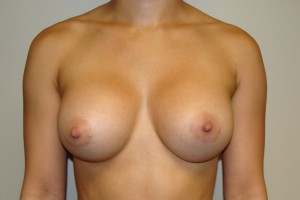 Breast Augmentation Before and After 226 | Sanjay Grover MD FACS