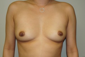 Breast Augmentation Before and After | Grover Aesthetics