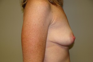 Breast Augmentation Before and After 228 | Grover Aesthetics