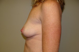 Breast Augmentation Before and After 228 | Grover Aesthetics