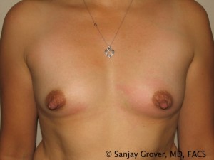 Breast Augmentation Before and After | Grover Aesthetics