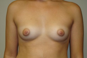 Breast Augmentation Before and After | Grover Aesthetics