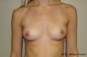 Breast Augmentation Before and After 313 | Sanjay Grover MD FACS