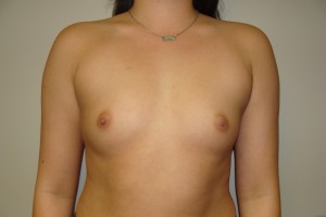 Breast Augmentation Before and After | Grover Aesthetics