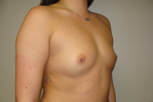 Breast Augmentation Before and After 232 | Grover Aesthetics