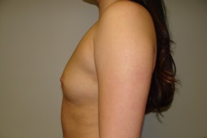 Breast Augmentation Before and After 232 | Grover Aesthetics