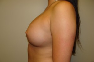 Breast Augmentation Before and After 232 | Grover Aesthetics