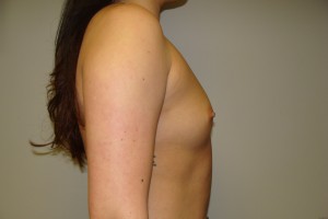 Breast Augmentation Before and After 232 | Grover Aesthetics