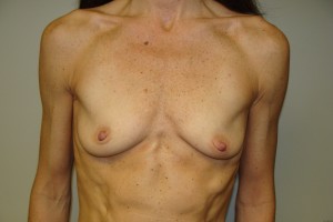 Breast Augmentation Before and After | Grover Aesthetics