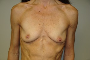 Breast Augmentation Before and After 132 | Sanjay Grover MD FACS