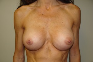 Breast Augmentation Before and After | Grover Aesthetics