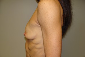 Breast Augmentation Before and After 237 | Grover Aesthetics