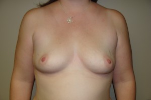 Breast Augmentation Before and After | Grover Aesthetics