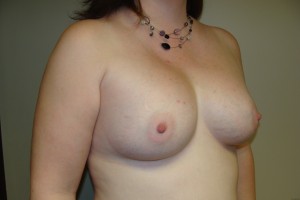 Breast Augmentation Before and After 238 | Grover Aesthetics