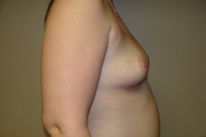 Breast Augmentation Before and After 238 | Grover Aesthetics