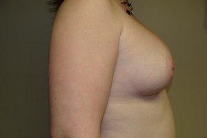Breast Augmentation Before and After 238 | Grover Aesthetics