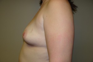 Breast Augmentation Before and After 238 | Grover Aesthetics