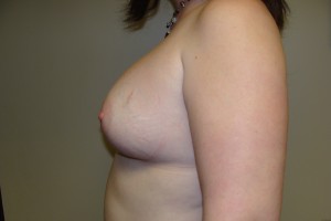 Breast Augmentation Before and After 238 | Grover Aesthetics