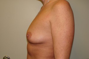 Breast Augmentation Before and After 239 | Grover Aesthetics
