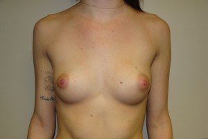 Breast Augmentation Before and After | Grover Aesthetics