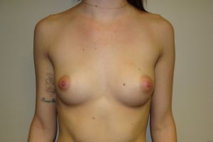 Breast Augmentation Before and After 247 | Sanjay Grover MD FACS