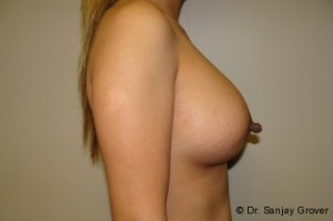 Breast Augmentation Before and After 240 | Sanjay Grover MD FACS