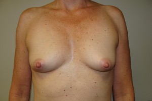 Breast Augmentation Before and After 283 | Sanjay Grover MD FACS