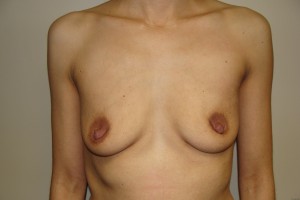 Breast Augmentation Before and After | Grover Aesthetics
