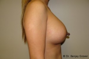 Breast Augmentation Before and After 243 | Grover Aesthetics