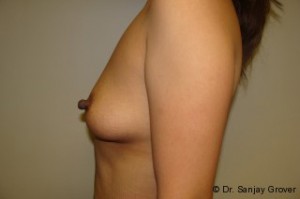 Breast Augmentation Before and After 243 | Grover Aesthetics