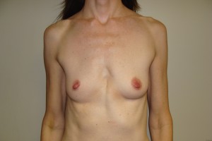 Breast Augmentation Before and After | Grover Aesthetics