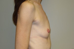 Breast Augmentation Before and After 245 | Grover Aesthetics