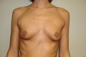 Breast Augmentation Before and After | Grover Aesthetics