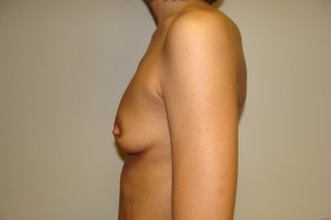 Breast Augmentation Before and After 247 | Grover Aesthetics